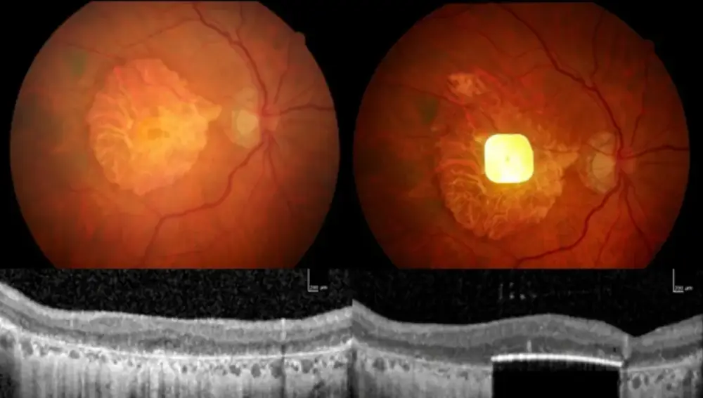 Eye of a patient before and after the implant.